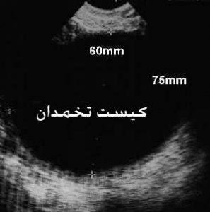 کیست تخمدان-جراح متخصص و فوق تخصص بیماری های زنان و زایمان و نازایی و ناباروری دکتر پریسا علمی بهترین متخصص زنان و زایمان خوب در تهران