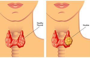 ندول منفرد تیروئید Thyroid nodule - دکتر پریسا علمی- بهترین متخصص و جراح زنان و زایمان