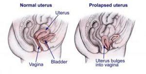 Uterine prolapse-پرولاپس رحم
