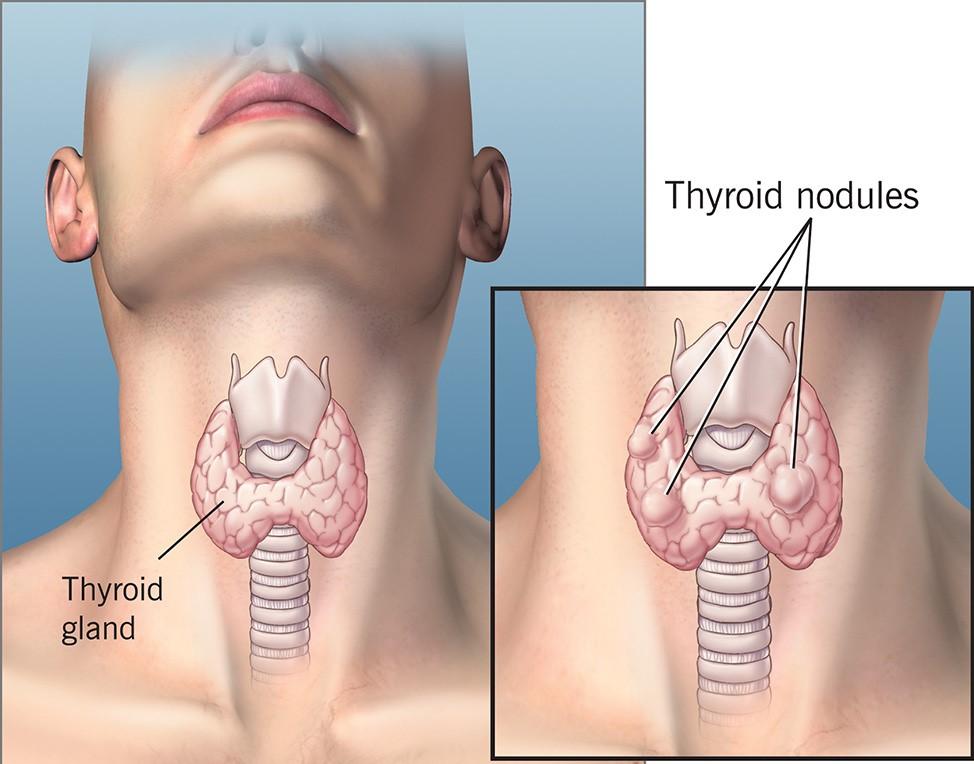 ندول منفرد تیروئید Thyroid nodule - دکتر پریسا علمی- بهترین متخصص و جراح زنان و زایمان