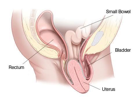 Uterine prolapse-پرولاپس رحم