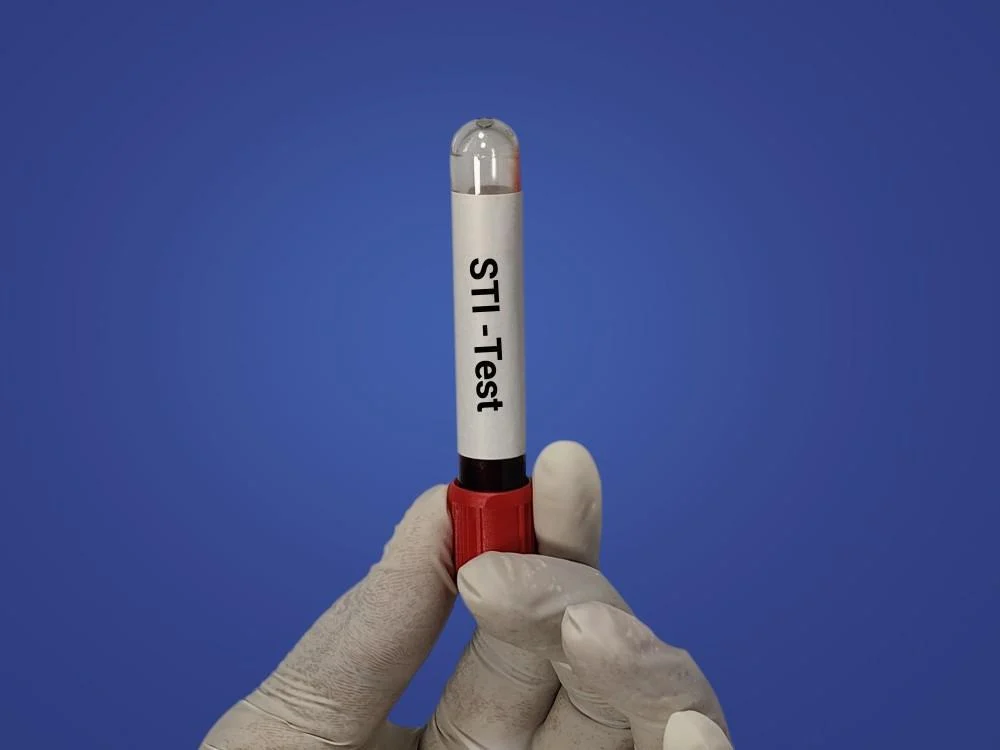 نمونه‌گیری ادرار برای آزمایش STD در مطب